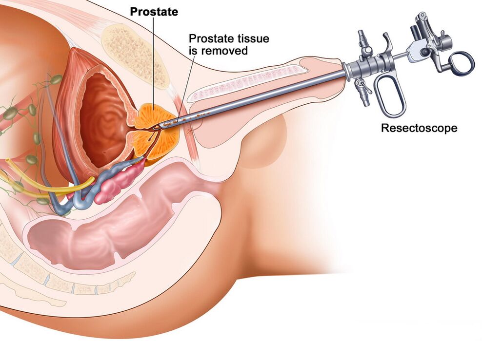 Eliminación do tecido prostático para o diagnóstico preciso da prostatite